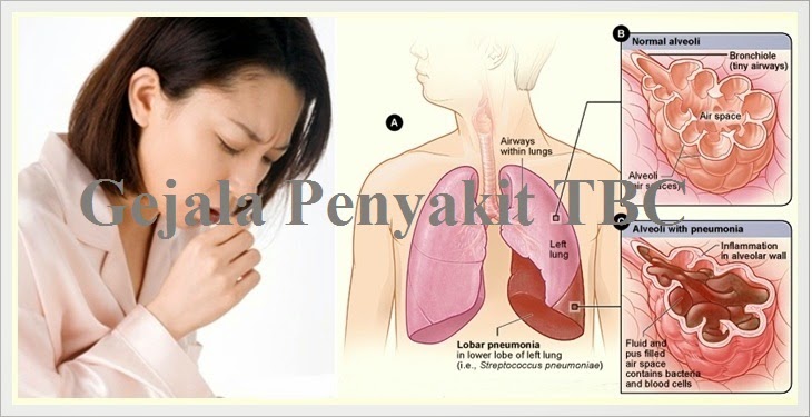 Gejala Penyakit TBC dan Cara Mengobatinya - Web Developer 